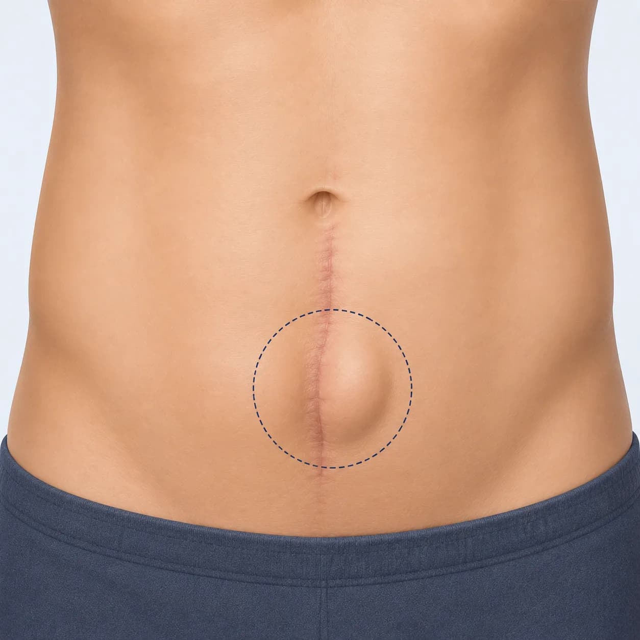 Incisional Hernia